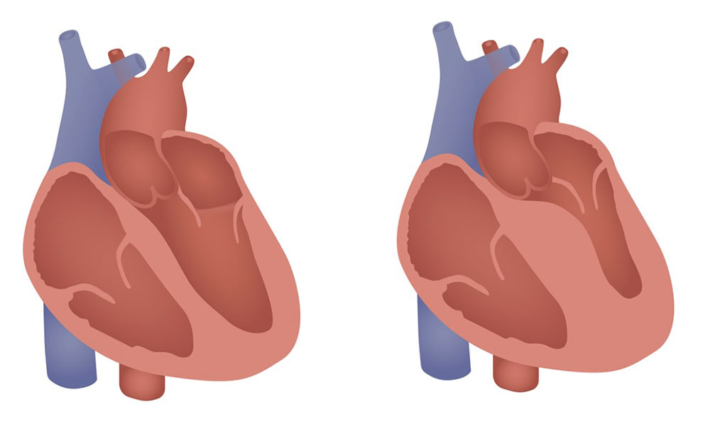 Coeur atteint de Cardiomyopathie hypertrophique (HCM)