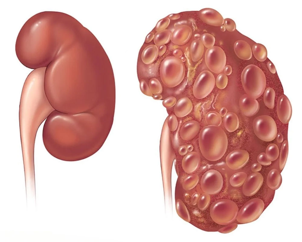 Rein atteint de PKD - Polykystic Kidney Disease